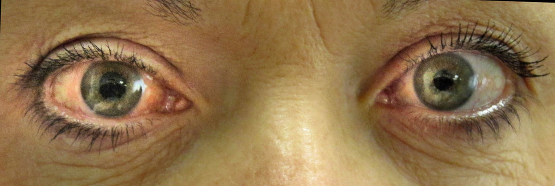 Glaucoma