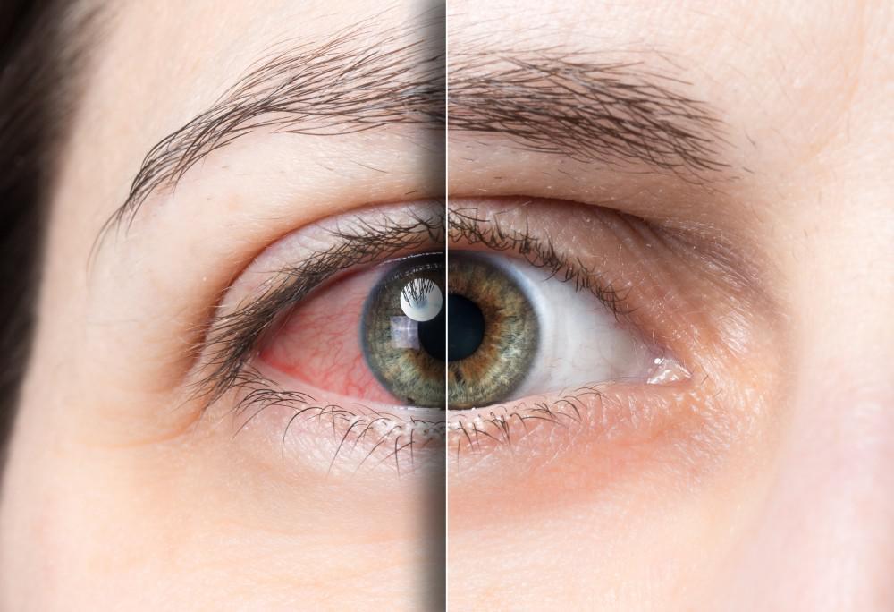 Side Effects of Contact Lenses