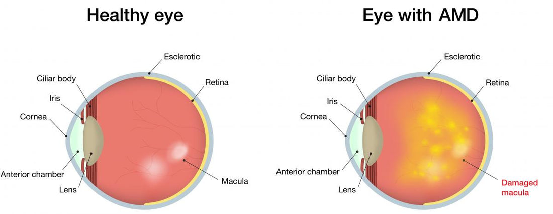 Age-Related Macular Degeneration (AMD)