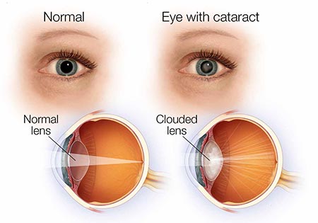 Cataract: Causes and Symptoms