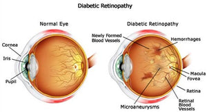 Diabetic retinopathy