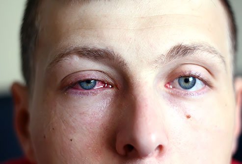 Type of Eye Infection