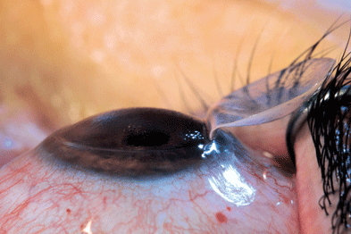 Can LASIK fix Astigmatism?